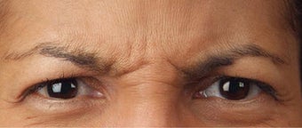 Botox before 391576