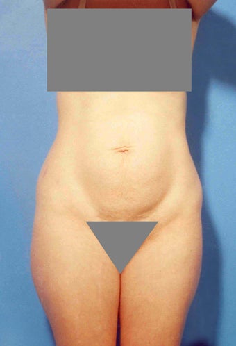 Abdominoplasty before 356352