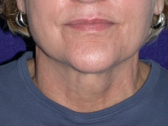 Necklift before 208457