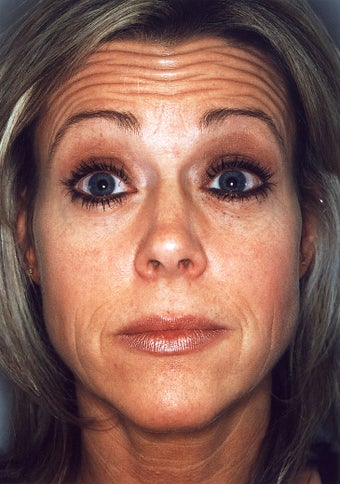 Botox before 628889