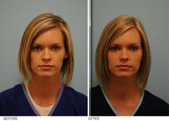 Facial Fillers for cosmetic Enhancement before 362593