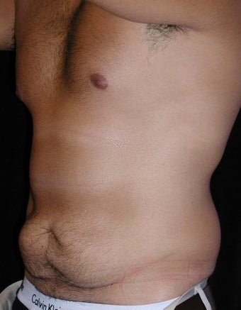 Male tummy Tuck, Flank Liposuction 578169