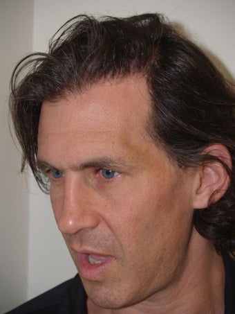 Hair Grafts 534765