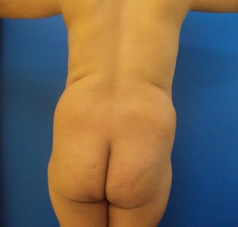 Brazilian Butt lift before 366996