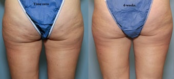 Cellulite Treatment Formula C9 after 641507