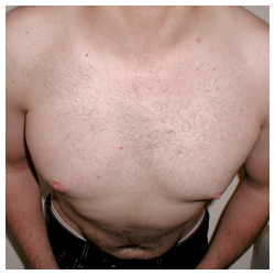 Chest implant for patient with Poland’s syndrome after 334390