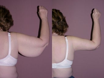 Arm Lift (Brachioplasty) before 350265