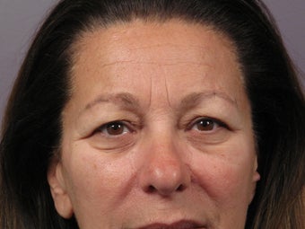 Eyelid Surgery before 306424