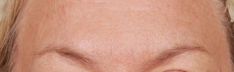 Botox after 269755