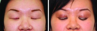 Double Eyelid Surgery Suture after 548933