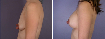 Breast Implants before 270009