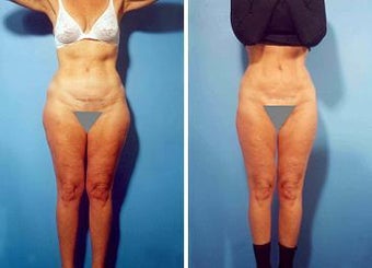Liposuction before 636262