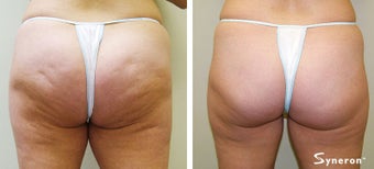 Velashape, after 5 treatments after 45489