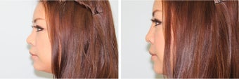 Nasal filler after 577824