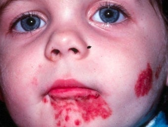PDL for port wine stain before 374570
