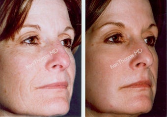 Non-Surgical Face Lift- Exoderm before 242967