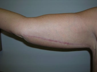 Arm Lift after 259014