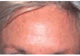 Botox after 154203