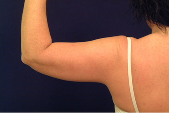 Liposuction 393227