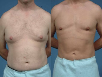 Male liposuction before 135573