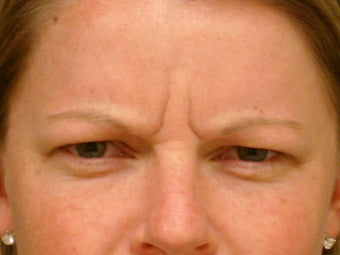 Botox Cosmetic before 375185