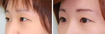 Double Eyelid Surgery - Suture Technique after 609875
