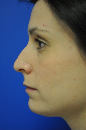 Nose surgery/Rhinoplasty before 498393