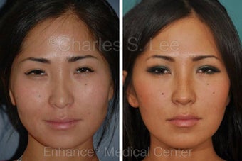 Nose before 431396
