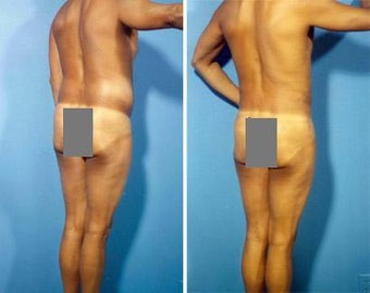 Liposuction before 636096