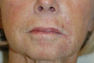 Juvederm for Smile Lines Long Beach, CA Before and After Pictures after 204767