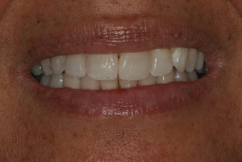 Invisalign after 206798