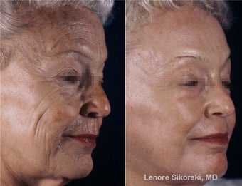 Full Face Erbium Laser before 106294