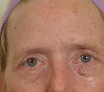 Pearl Laser Treatment after 102779