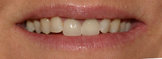 Veneers before 343105
