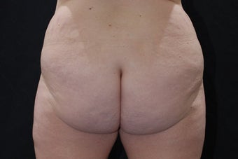Buttock Augmentation through Fat Transfer before 423709