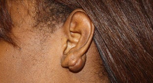 Earlobe Keloid 494466
