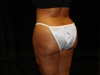 Buttocks Augmentation 517579