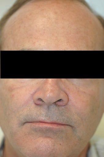 Dysport (Botox) for Forehead Wrinkles, Los Angeles, CA after 424745