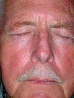 PDT for rosacea after 376120