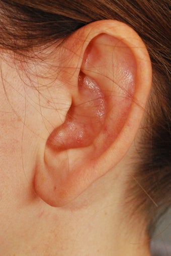 Otoplasty 604375
