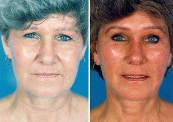 Facelift before 643027