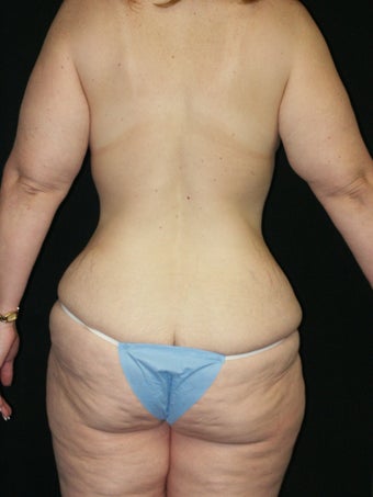 Belt Lipectomy and Breast Lift 379775