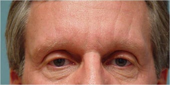Botox frown lines after 251660