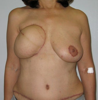 Nipple Reconstruction before 523521