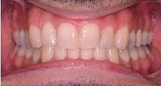 Invisalign after 353426