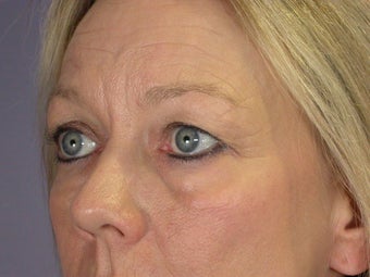 Eyelid Surgery before 306431