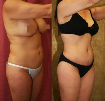 tummy tuck 304698