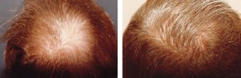 Medical treatment for hair loss (no surgery) before 369179