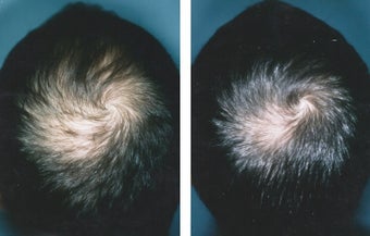 Medical treatment for hair loss (no surgery)` before 369182