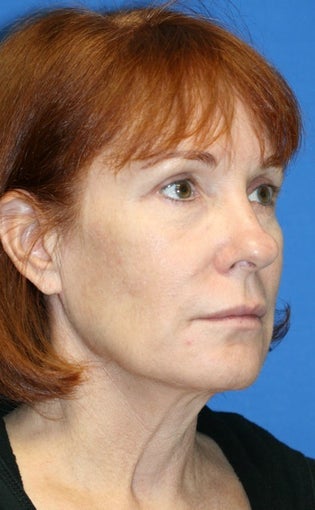 2 years post op: Facelift, Lower Eyelid Skin Pinch, and Peri-orbital Fat Transfer 424184